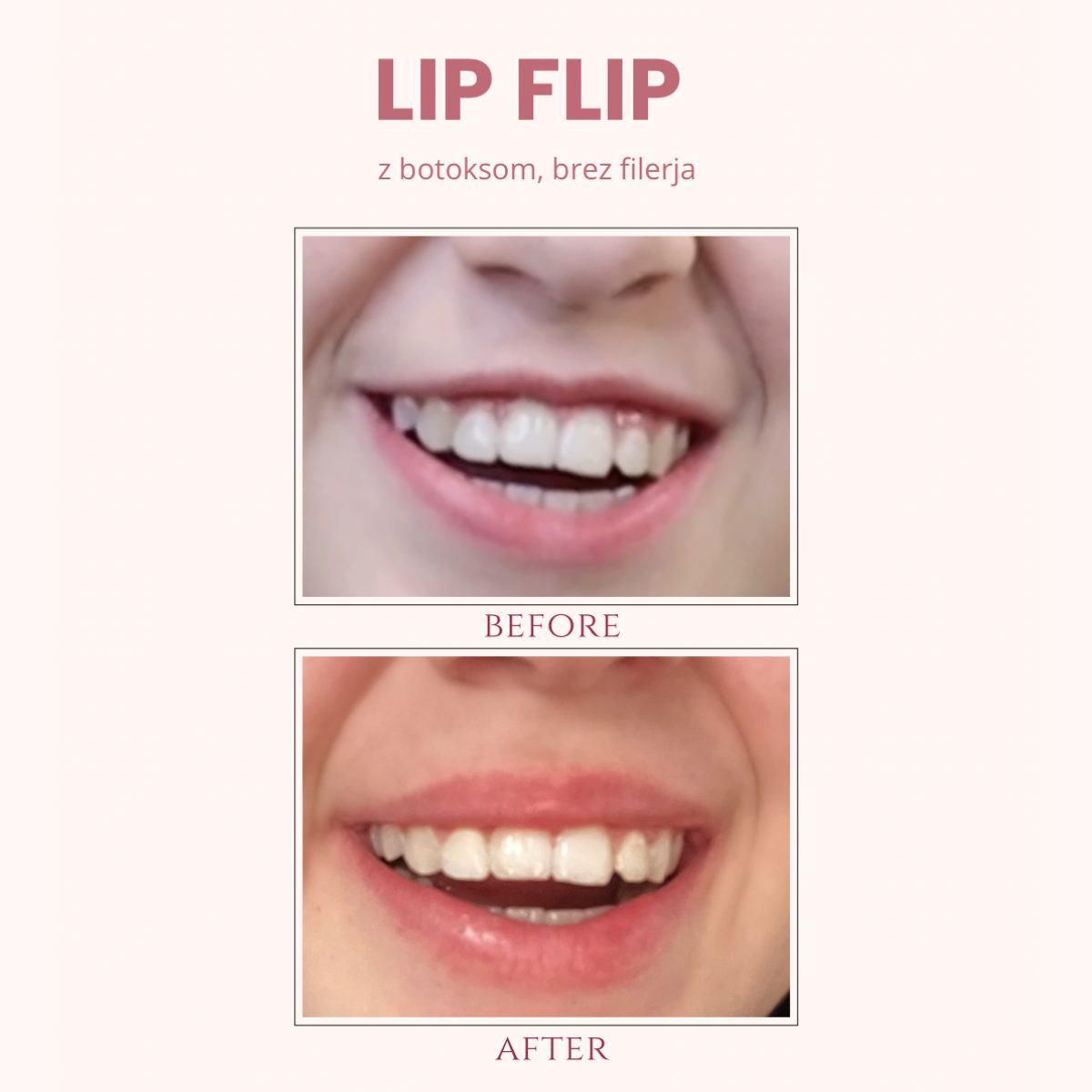 Lip flip rezultat pred po